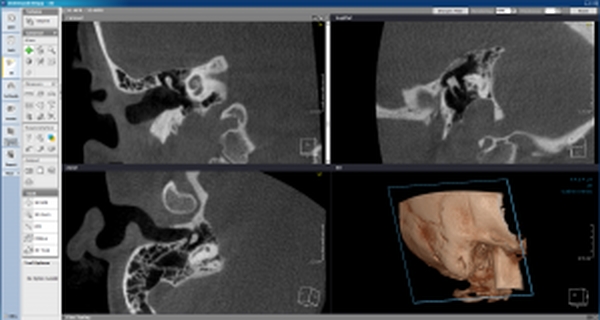 Cone beam CT OD3DApp temporal bone-orl-300x160