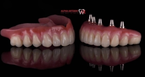 Reabilitare protetică pe implanturi dentare